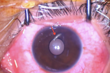 Chàng trai 28 tuổi bị "vật thể lạ" cắm sâu vào mắt khi sửa xe máy