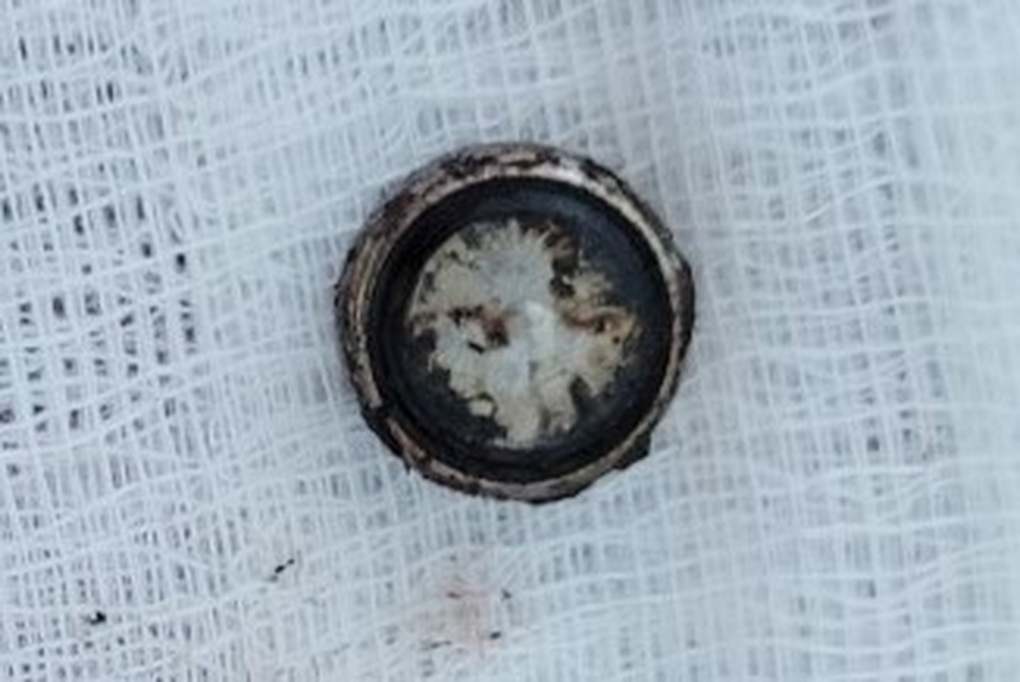 Cục pin bị cháy khét trong mũi bé gái 4 tuổi - 1