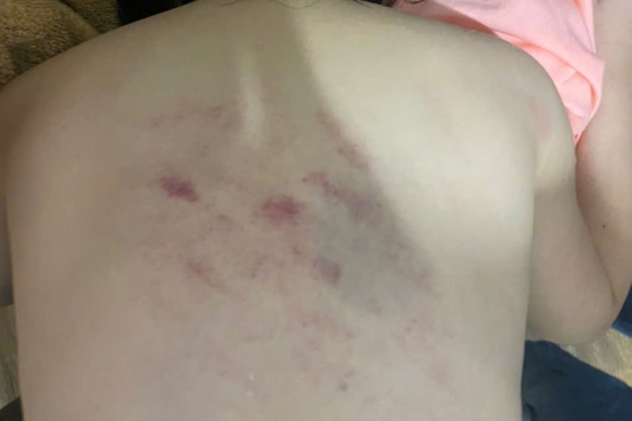 Profesor suspendat pentru impact fizic care i-a provocat vânătăi la spate elevului - 2 Đình chỉ công tác cô giáo tác động vật lý khiến học sinh thâm tím lưng - 2