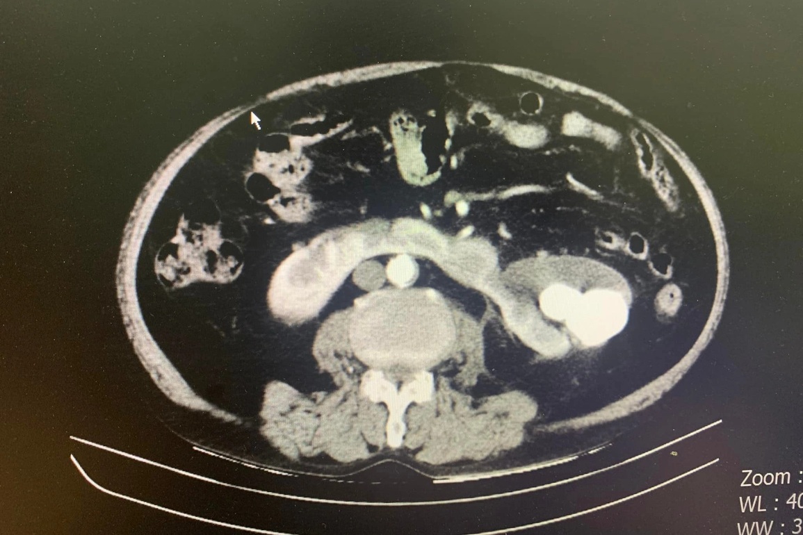 Đi khám vì đau lưng bất ngờ phát hiện thận hình... móng ngựa - 1 Đi khám vì đau lưng bất ngờ phát hiện thận hình... móng ngựa - 1