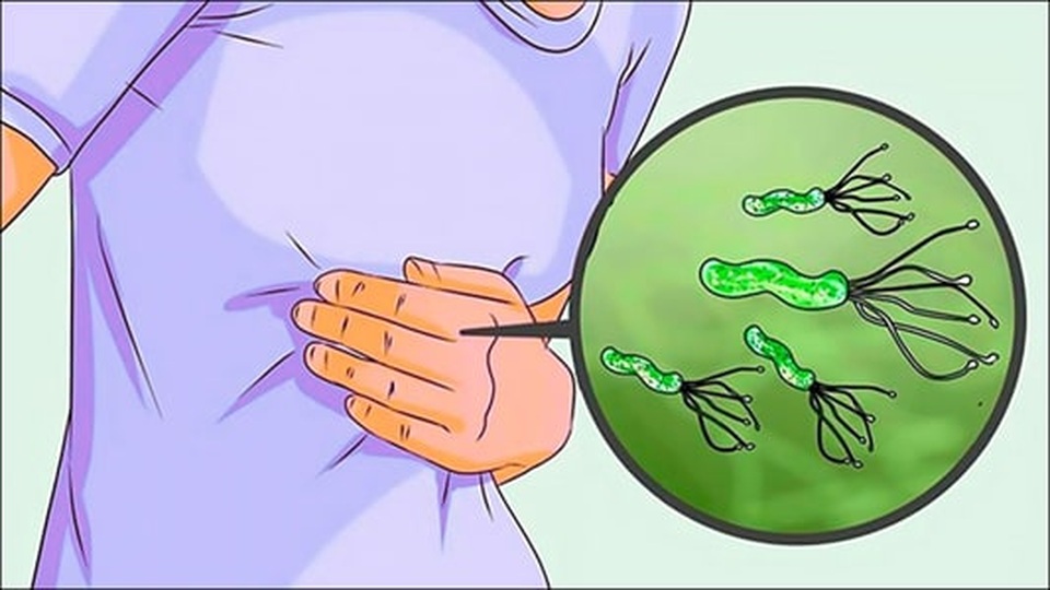 Vi khuẩn H.P và ung thư dạ dày - 2 Vi khuẩn H.P và ung thư dạ dày - 2