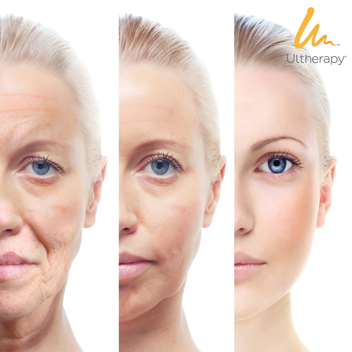 Đẩy lùi lão hóa sớm với công nghệ nâng cơ, căng da Ultherapy - 1 Đẩy lùi lão hóa sớm với công nghệ nâng cơ, căng da Ultherapy - 1