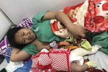 Bé trai bị gãy xương đùi trái khi sinh mổ