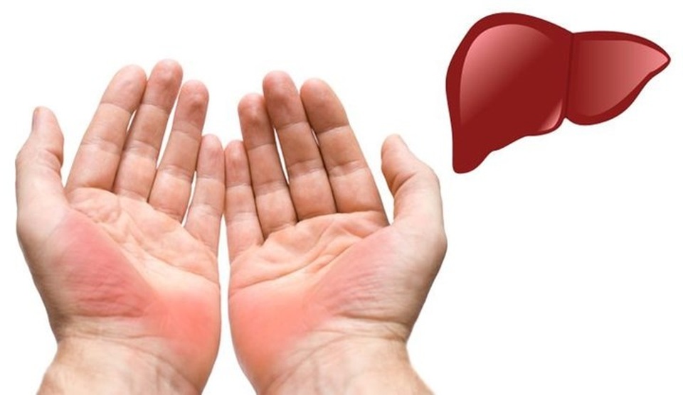 Mũi bỗng nhiên đỏ ửng có thể là lời cầu cứu của cơ thể khi gan gặp vấn đề - 5 Mũi bỗng nhiên đỏ ửng có thể là lời cầu cứu của cơ thể khi gan gặp vấn đề - 5