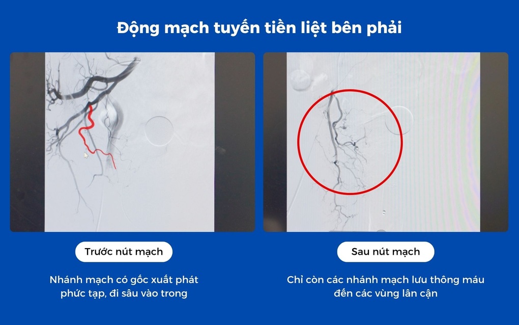 Nút mạch tuyến tiền liệt điều trị cơn đau tiểu cho bệnh nhân cao tuổi - 4 Nút mạch tuyến tiền liệt điều trị cơn đau tiểu cho bệnh nhân cao tuổi - 4