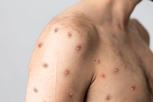 Bình Dương ghi nhận ca đậu mùa khỉ là bạn gái ca bệnh ở Đồng Nai