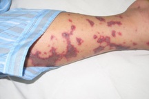 Sốt sắng lo vắc xin não mô cầu cho mùa hè