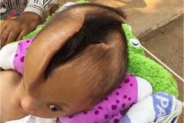 Sốc với cậu bé có rãnh hộp sọ nứt rộng hơn mỗi tuần