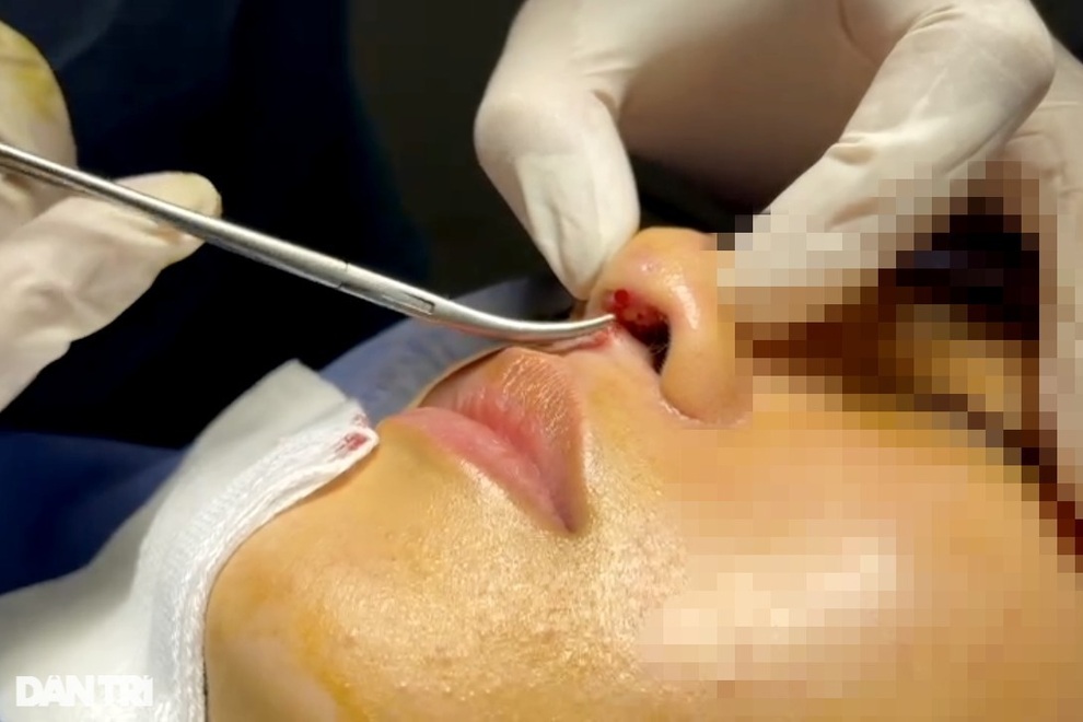Nhiều chị em cắt mí, nâng mũi lỗi ở TPHCM nhập viện khẩn sau giãn cách - 1 Nhiều chị em cắt mí, nâng mũi lỗi ở TPHCM nhập viện khẩn sau giãn cách - 1