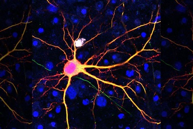 Công nghệ chỉnh sửa gene mới có thể giúp điều trị bệnh Huntington