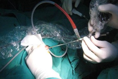 Hiếm gặp bé 2 tuổi bí tiểu do sỏi niệu gây bít tắc