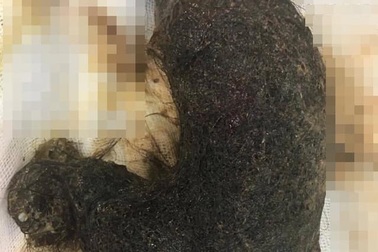 Kinh hoàng búi tóc khổng lồ chiếm gần hết dạ dày bé gái 11 tuổi