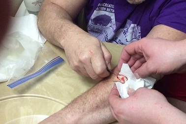 Cận cảnh người đàn ông tự lấy cục u nang ở cánh tay