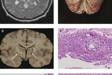 Đề phòng bệnh nhiễm não mô cầu trở lại