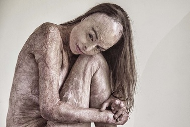 Cảm phục nghị lực sống của Hoa hậu bị bỏng 85% cơ thể