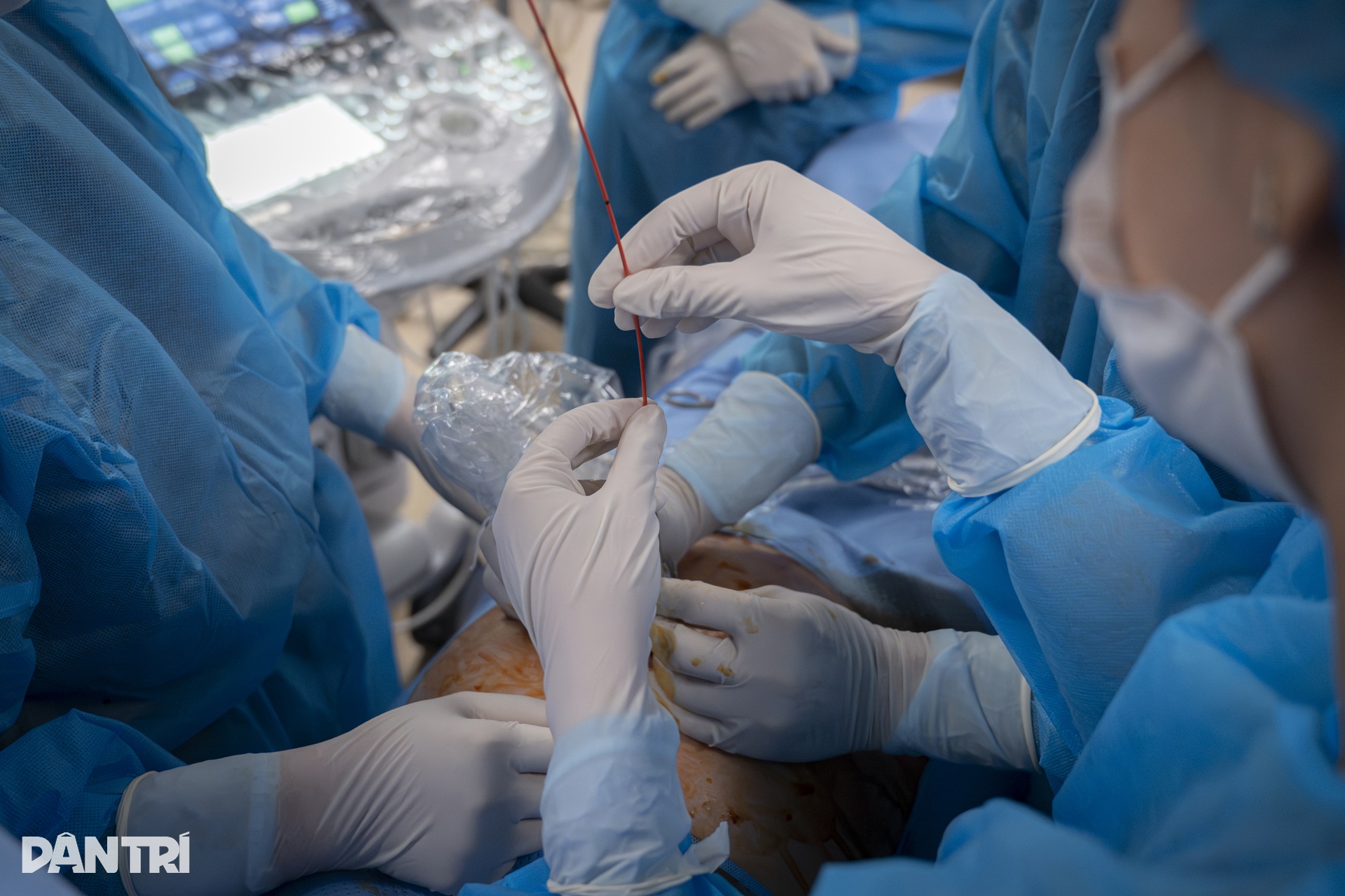 Doktor menggunakan jarum sebagai benang untuk menyelamatkan Bác sĩ dùng kim như sợi chỉ cứu “thiên thần” tràn dịch phổi trong bụng mẹ - 15
