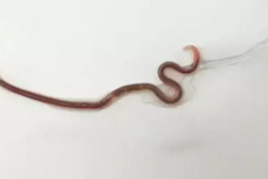 Rùng mình bác sĩ gắp giun 3,8 cm ra khỏi miệng người phụ nữ ăn cá sống