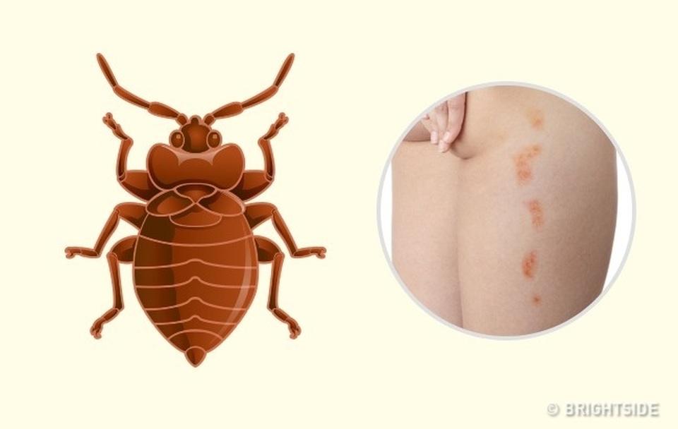 Cách phân biệt 10 vết côn trùng cắn - 10 Cách phân biệt 10 vết côn trùng cắn - 10