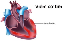Hà Nội thông tin về hai ca tử vong viêm cơ tim do  "virus lạ" gây xôn xao