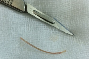 Thủng ruột vì “ăn” xương cá, tăm xỉa răng