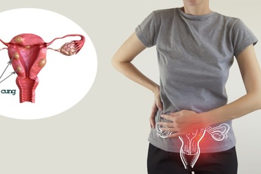 U xơ tử cung và những nguy cơ khó lường chị em cần biết