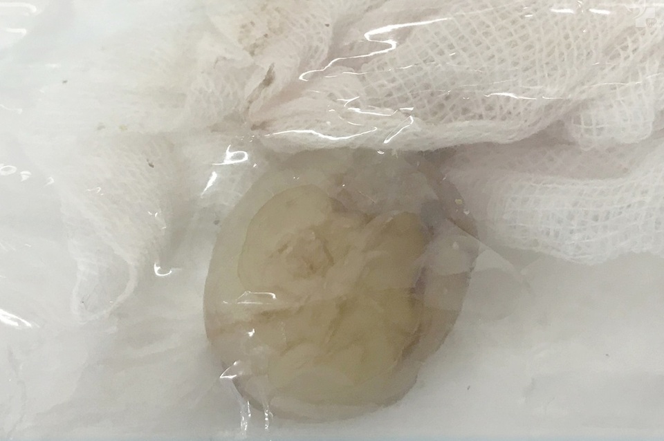 Bé 1 tuổi tổn thương não vì hóc chôm chôm - 2 Bé 1 tuổi tổn thương não vì hóc chôm chôm - 2