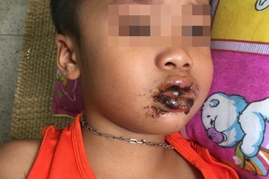 Nhầm bột thông cống là đường, 4 bé cùng nhập viện