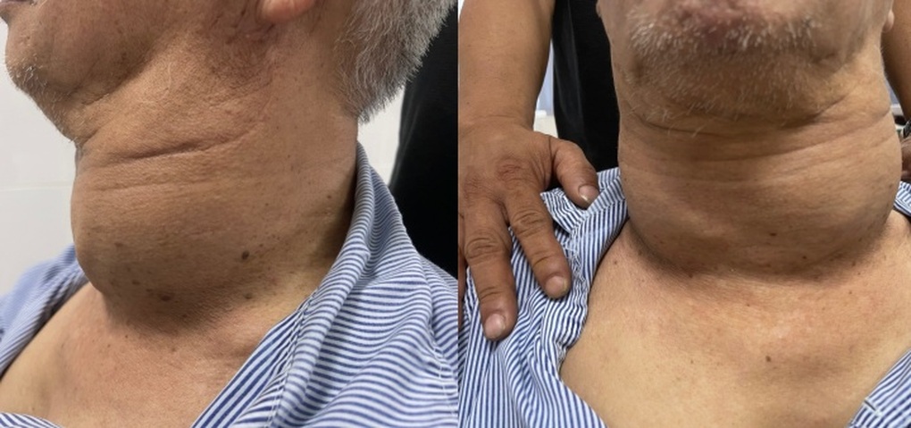 Khối u hai bên to như 2 quả bưởi khiến cụ ông khó ăn uống - 1
