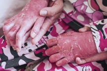 Nhiều người trong nhà vừa mắc vảy nến, vừa bị ung thư máu: Bác sĩ nói gì?