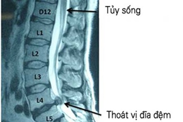 Thoát vị đĩa đệm: Từ chẩn đoán đến điều trị