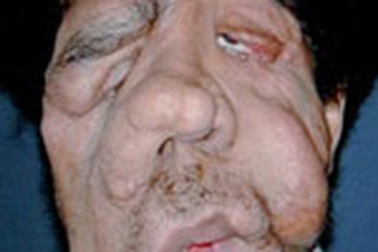 “Người voi” và ca ghép mặt toàn diện đầu tiên trên thế giới