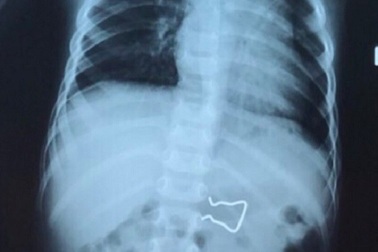 Móc sắt nằm gọn trong ruột bé 18 tháng tuổi