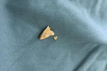 Sốt, ho, nặng ngực suốt 6 tháng do mảnh xương nằm trong phế quản