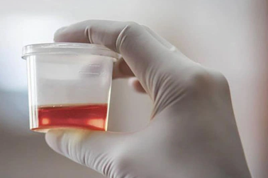 6 dấu hiệu của ung thư tiết niệu