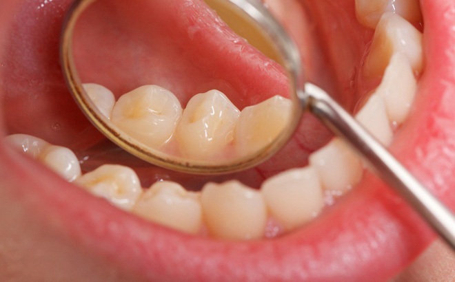 Răng sâu và vỡ răng giả có thể gây ra mảng trắng trong miệng không?
