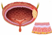 Trẻ em có mắc ung thư bàng quang không?