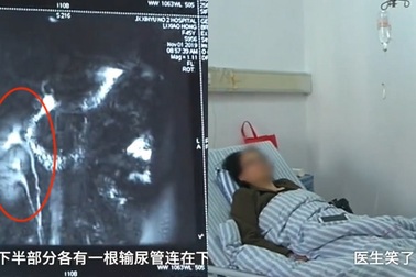 Phát hiện có 3 quả thận, đồng ý cho bớt 1 quả