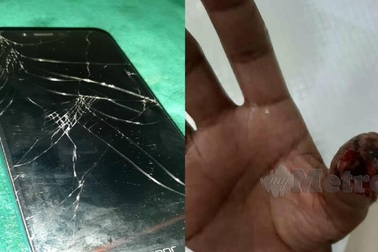 Suýt mất ngón tay vì sử dụng smartphone với tấm dán cường lực màn hình bị vỡ