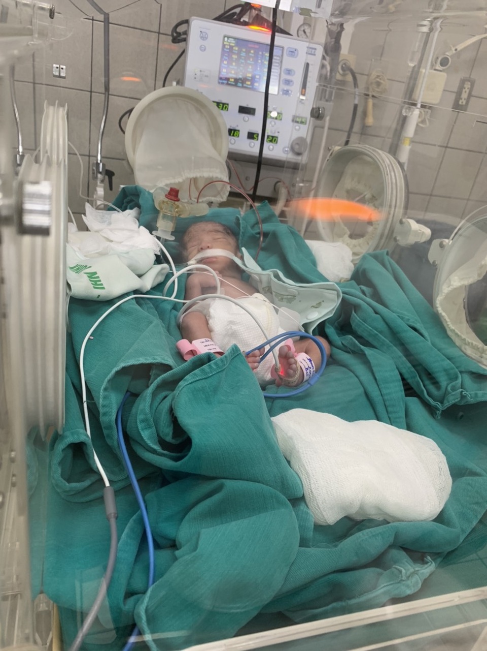 Thai phụ nguy kịch buộc phải mổ bắt con cầu cứu các nhà hảo tâm giúp đỡ - 3 Thai phụ nguy kịch buộc phải mổ bắt con cầu cứu các nhà hảo tâm giúp đỡ - 3