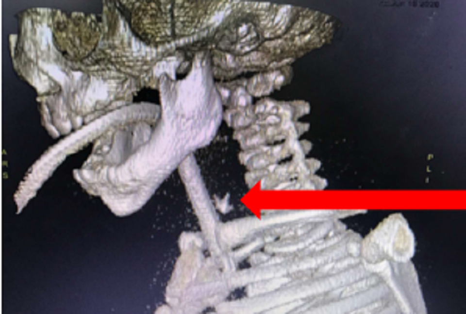 Mẹ cho ăn dặm, bé trai bị xương lươn đâm thủng thực quản - 1 Mẹ cho ăn dặm, bé trai bị xương lươn đâm thủng thực quản - 1