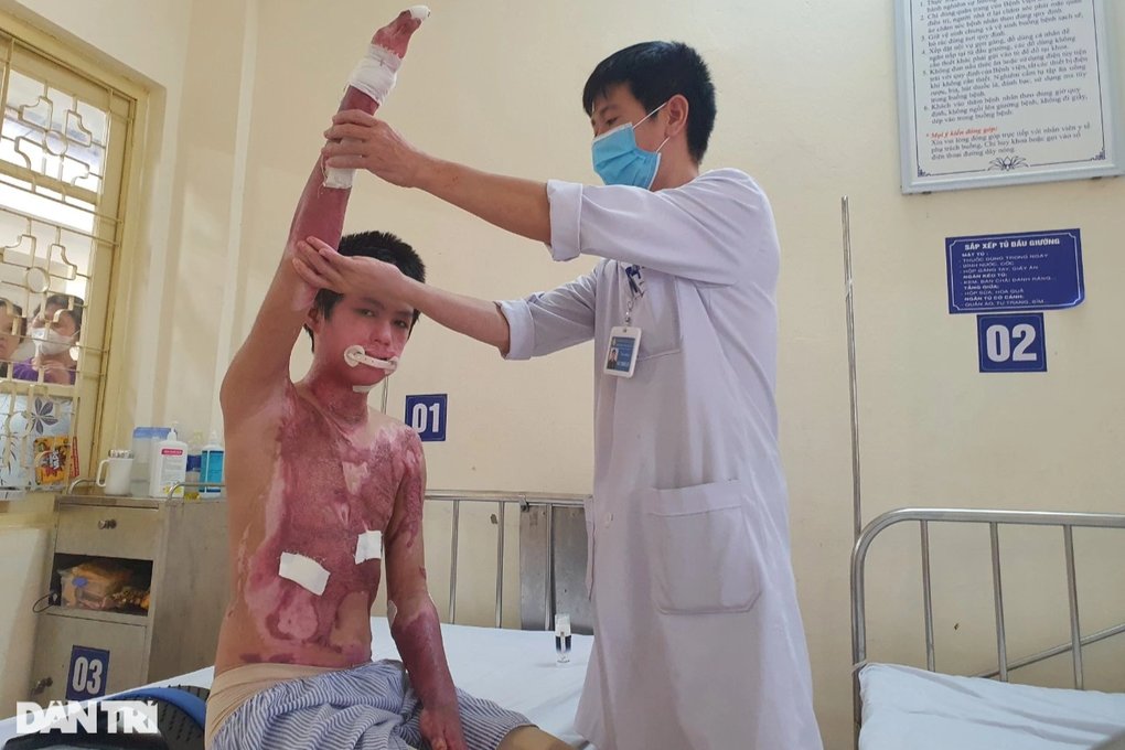 Cú phóng điện cao thế khiến cậu bé 14 tuổi bỏng 55% cơ thể, tay biến dạng - 2 Cú phóng điện cao thế khiến cậu bé 14 tuổi bỏng 55% cơ thể, tay biến dạng - 2