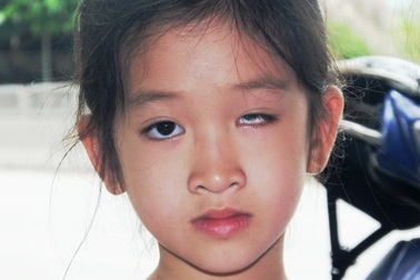 Tòa án sẽ xét xử vụ học sinh bị trúng thước, mù một mắt