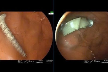 Nuốt đinh vít dài 4cm, bé gái 11 tháng tuổi nguy kịch