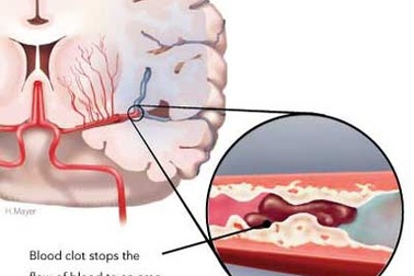 Chớ coi thường chứng mỡ máu cao!