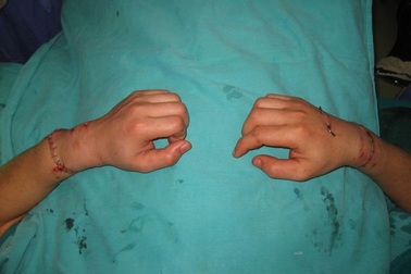 Nối các bộ phận đứt rời: 85% trường hợp thành công