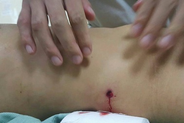 Hà Nội: Cứu sống cô gái bị đạn bắn thủng bụng