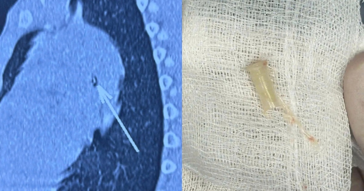 Bé trai 7 tuổi phải đi cấp cứu ở 3 bệnh viện vì "thở ra tiếng kèn"