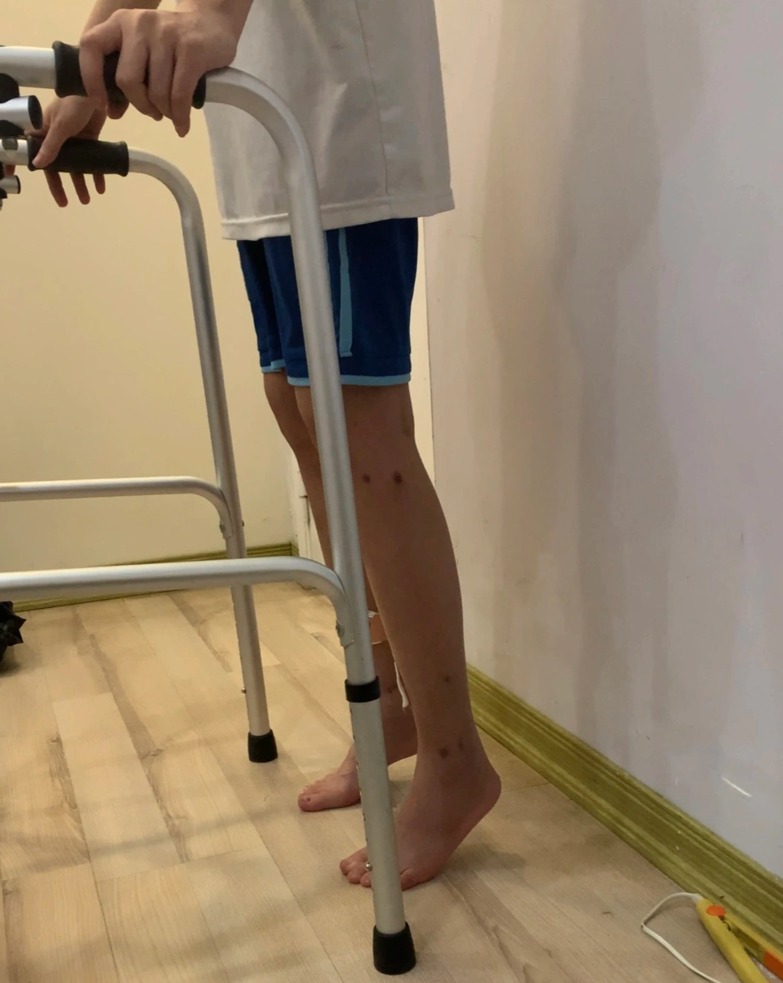 9x kéo chân 7cm: Cao thêm 1mm mỗi ngày, tập đi như em bé - 5 9x kéo chân 7cm: Cao thêm 1mm mỗi ngày, tập đi như em bé - 5
