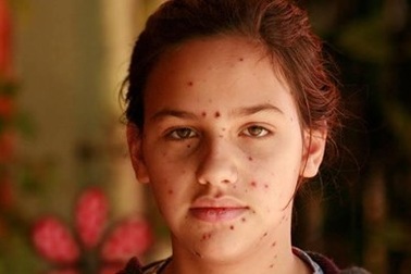 Vitamin B12 có thể khiến da rối loạn và nổi mụn