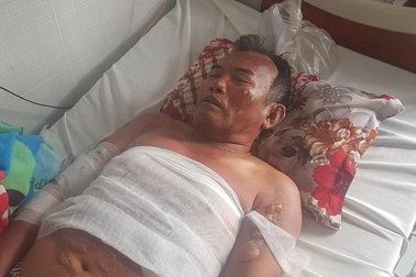 Hai vợ chồng bỏng nặng do rò rỉ khí gas khi nấu ăn